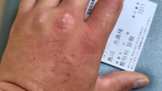 ひと晩したら手の甲が腫(は)れたので、病院行きました-2025-07-08
